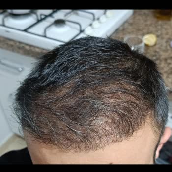 Saç Ekiminde Yüksek Adrenalin Ve Nekroz Mağduriyeti