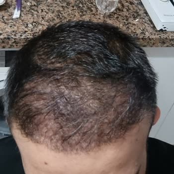 Saç Ekiminde Yüksek Adrenalin Ve Nekroz Mağduriyeti