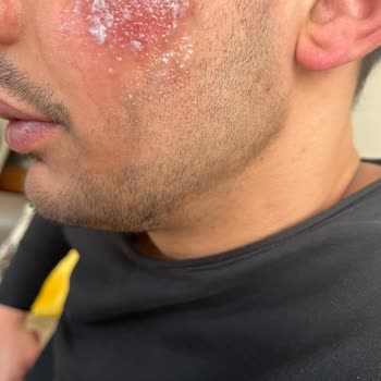 Bee Beauty Yüz Ağda Bandı Kullanımı Sonrası Ciltte Yanık Oluştu
