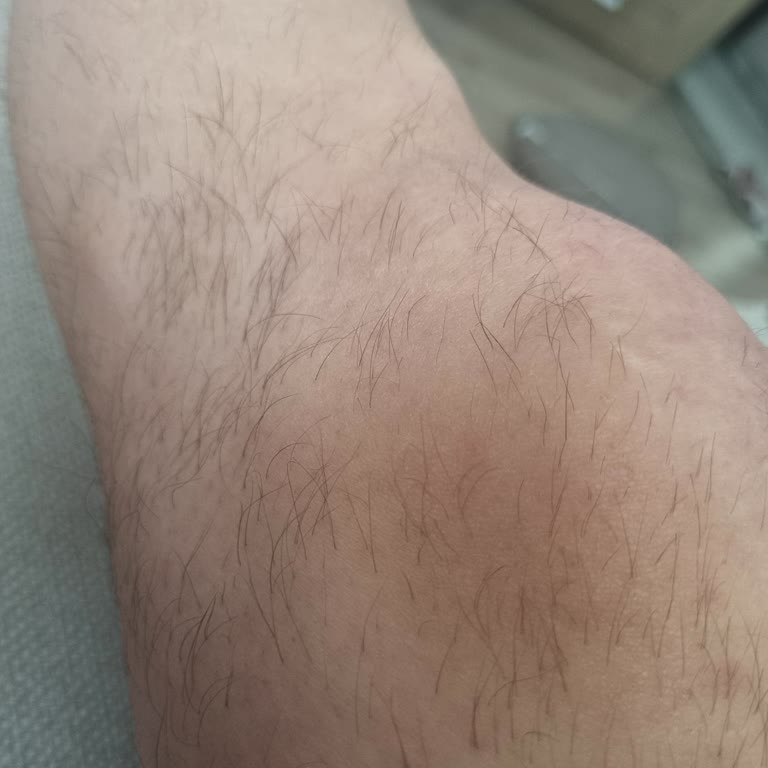 Lazer Epilasyon Seanslarında Personel Sürekliliği Ve Sonuçsuz Hizmet Sorunu