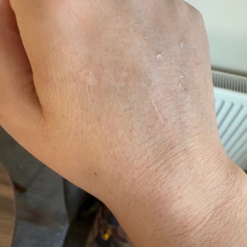 Anestezi Hemşirelerinin İlgisiz Ve Sert Davranışı Sonucu Yaşadığım Mağduriyet