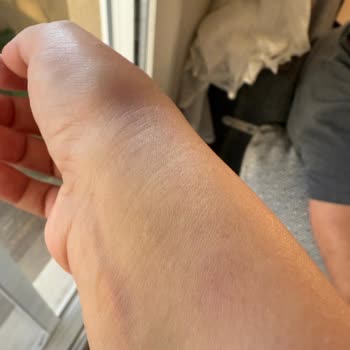 Anestezi Hemşirelerinin İlgisiz Ve Sert Davranışı Sonucu Yaşadığım Mağduriyet