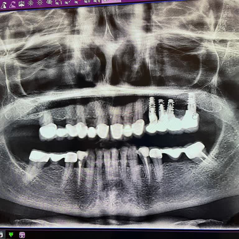 Yanlış Ve Yetersiz Diş İmplantı Uygulaması Sonrası Mağduriyet