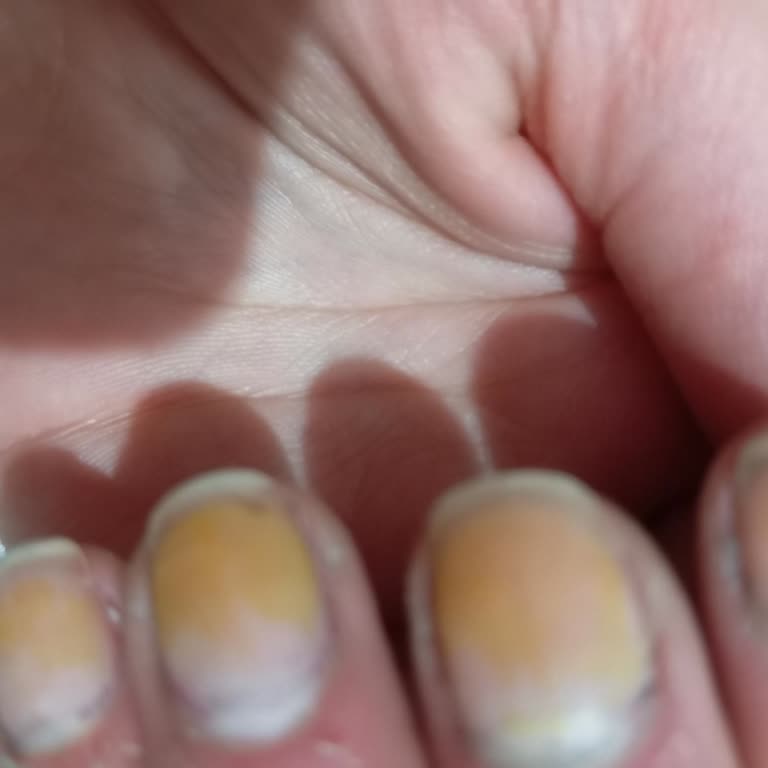 Oje Sorununa Acil Ve Net Çözüm Bekliyorum