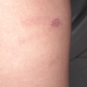 Lazer Epilasyon Sonrası Bacaklarımda Yanık Oluştu