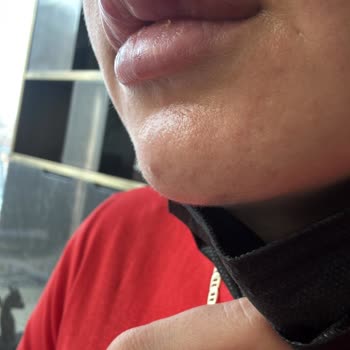 Dudak Dolgusu Sonrası Hayal Kırıklığı Ve Asimetri Sorunu