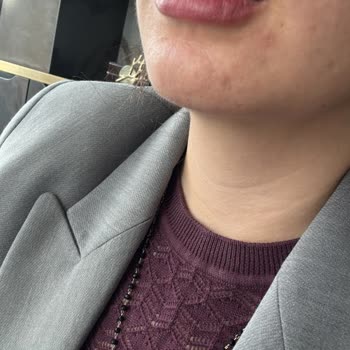 Dudak Dolgusu Sonrası Hayal Kırıklığı Ve Asimetri Sorunu