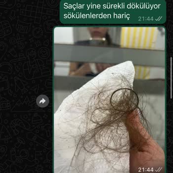 Kaynak Saç İşlemi Sonrası Dökülme Ve Renk Sorunu Yaşadım