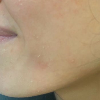 Loreal Revitalift Lazer Serum Cildimde Ciddi Hasara Yol Açtı, Acil Destek Bekliyorum