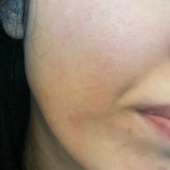 Loreal Revitalift Lazer Serum Cildimde Ciddi Hasara Yol Açtı, Acil Destek Bekliyorum