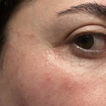 Аллергия на крем для глаз Clinique All About Eyes