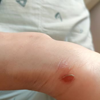 Aldığım Bot Ayağımı Yaraladı, Mağaza Çözüm Sunmuyor