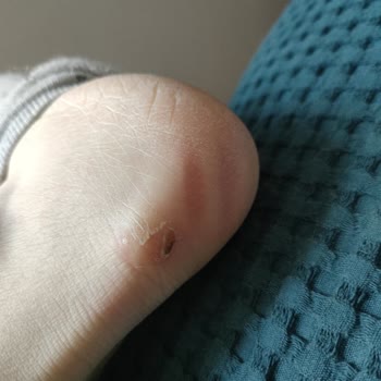 Aldığım Bot Ayağımı Yaraladı, Mağaza Çözüm Sunmuyor