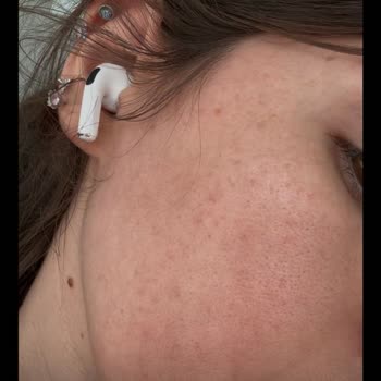 Dermoskin Ürünleri Yüzümde Yanma Ve Hassasiyete Yol Açtı