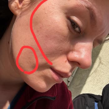 Dermoskin Ürünleri Yüzümde Yanma Ve Hassasiyete Yol Açtı