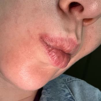 Dermoskin Ürünleri Yüzümde Yanma Ve Hassasiyete Yol Açtı