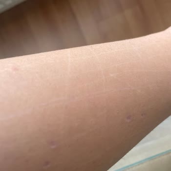 Glam Life Güzellik Merkezi Yaptıkları Hatayı Düzeltmek İçin Bile Para Talep Ediyorlar