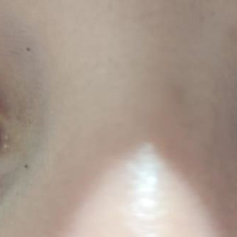 Kirpik Liftingi Sonrası Mağduriyet Ve İlgisiz Davranış