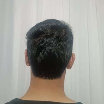 Başarısız Kepçe Kulak Ameliyatı Ve İlgisiz Doktor Deneyimi