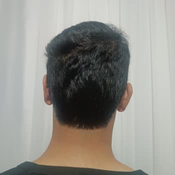 Başarısız Kepçe Kulak Ameliyatı Ve İlgisiz Doktor Deneyimi