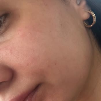 Riche Creme Krem Yüzümde Ciddi Tahrişe Sebep Oldu, İade Talebim Karşılanmıyor