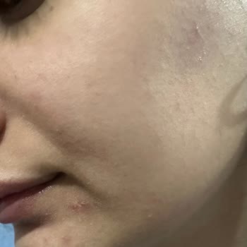 Riche Creme Krem Yüzümde Ciddi Tahrişe Sebep Oldu, İade Talebim Karşılanmıyor