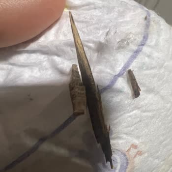 Prima Bebek Bezinde Odun Parçası Çıkması Ve Güven Kaybı