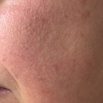 Daha Önce Sorunsuz Kullandığım Krem Cildimi Mahvetti, İade Ve Tedavi Talep Ediyorum