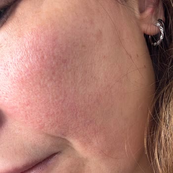 Daha Önce Sorunsuz Kullandığım Krem Cildimi Mahvetti, İade Ve Tedavi Talep Ediyorum