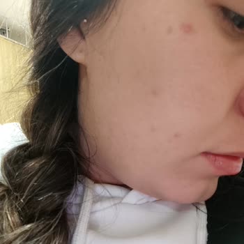 Yves Rocher Skincare Broke Out My Skin and Left Me Covered in Painful Acne