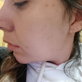 Yves Rocher Skincare Broke Out My Skin and Left Me Covered in Painful Acne