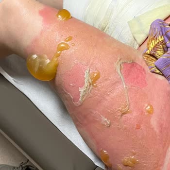 Termosun Patlaması Sonucu Yaşanan Yanık Ve Güvenlik Sorunu