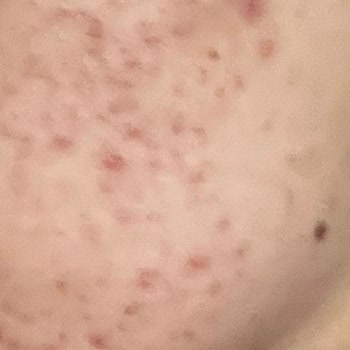 Viaderma Yüz Yıkama Jeli Ve Leke Kremi Yüzümü Mahvetti