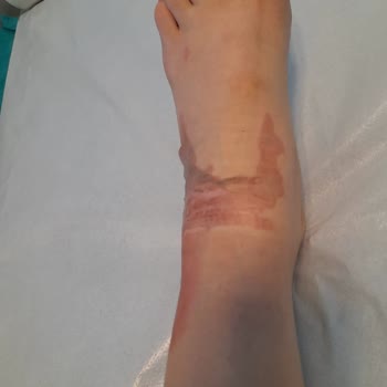 Şoför Seyir Halindeyken Kahve Yaparken Kaynar Suyla Yolcunun Ayağını Yaktı