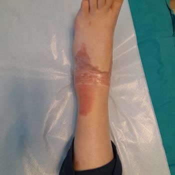 Şoför Seyir Halindeyken Kahve Yaparken Kaynar Suyla Yolcunun Ayağını Yaktı