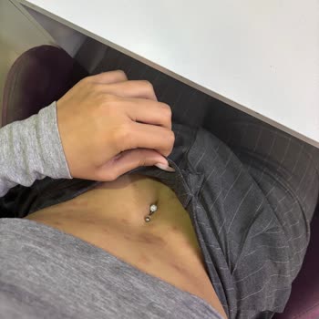 Lazer Epilasyon Sonrası Ciddi Yanık Ve Mağduriyet: Klinik İhmali Ve Hukuki Süreç Tehdidi