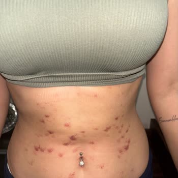 Lazer Epilasyon Sonrası Ciddi Yanık Ve Mağduriyet: Klinik İhmali Ve Hukuki Süreç Tehdidi