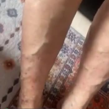 Özel Ümit Hastanesi Ameliyat Sonrası Damarların Hali!