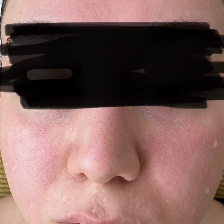 Missha Pirinç Maskesi Yüzümde Yanma Ve Tahrişe Sebep Oldu