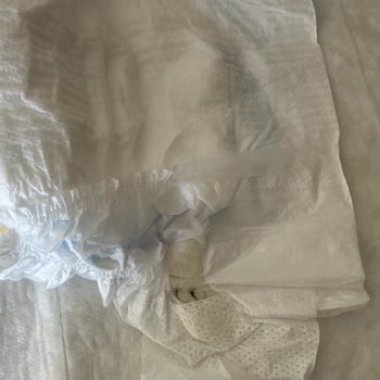 Bebek Bezinde Yabancı Cisim Tedirginliği