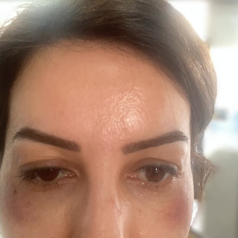 Now Life Clinic Kadıköy Göz Kapağımı Düşürdüler