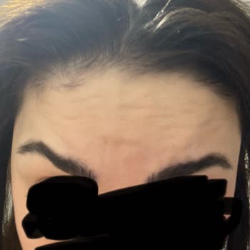 Botoks İşlemi Sonrası İlgi Ve Memnuniyetsizlik Sorunu