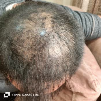 Batçı Hair Atelier 3 Kere Uygulama Yaptım Sonuç Hep Aynı