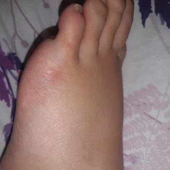 Aldo Shoes Ayağımı Mahvetti