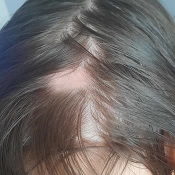 Morfose Kuru Şampuan Saç Dökülmesi Ve Saçkıran Sorunu Yaşattı