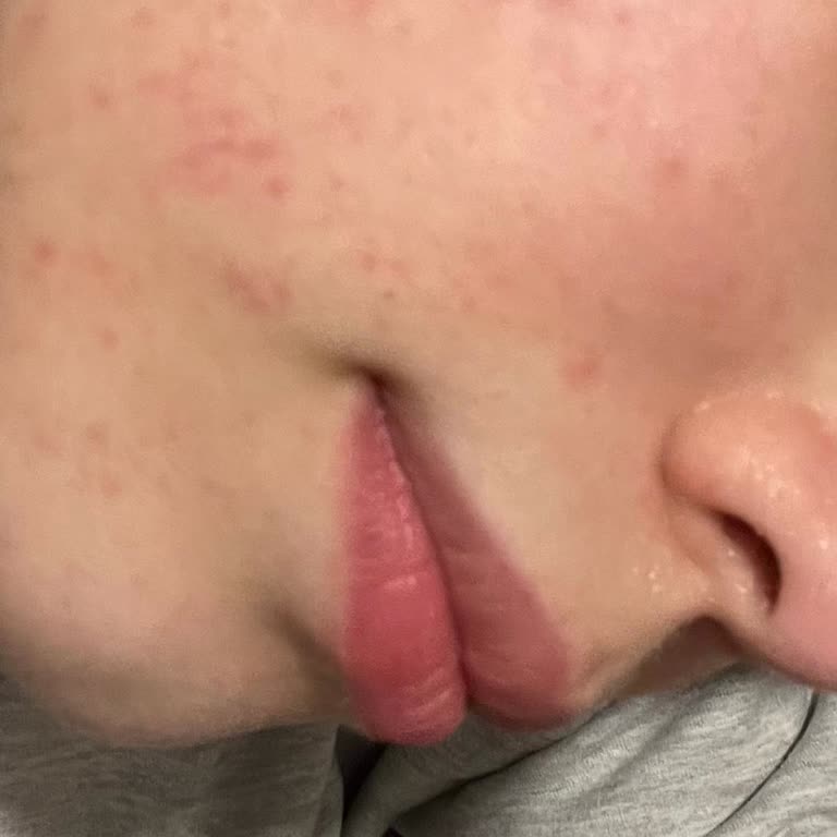 Maruderm C Vitamini Serumu Sonrası Cildimde Dökülme ve Yanıklar Oluştu