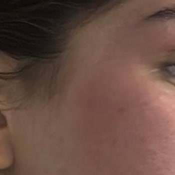 Bebek Şampuanı Yüzümde Yanık Ve Kızarıklığa Sebep Oldu