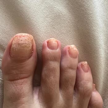 Flormar Oje Tırnaklarımı Zarar Verdi, Şirket İlgisiz Kaldı