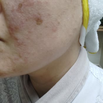 Tüy Sarartıcı Krem Cildimde Yaraya Sebep Oldu