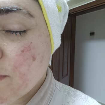 Tüy Sarartıcı Krem Cildimde Yaraya Sebep Oldu